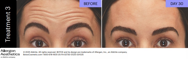 Botox before and after: forehead lines at Day 30