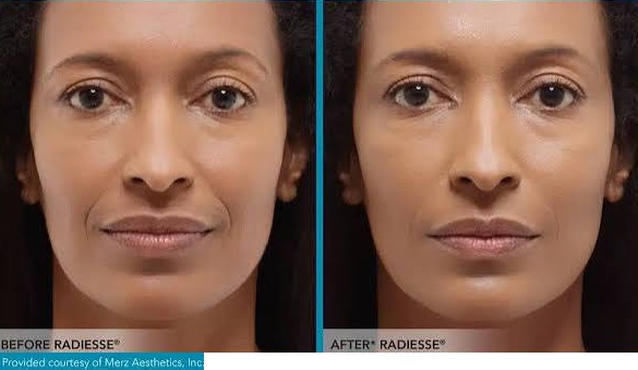 Radiesse before and after