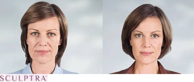 Sculptra before and after