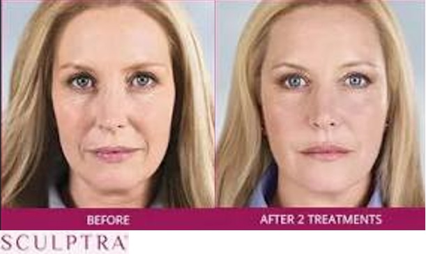 Sculptra before and after